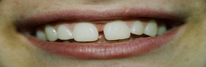 GapGate
