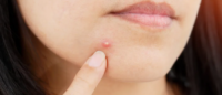 Don’t Pay For Pimples